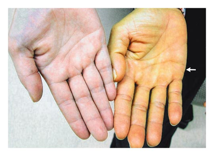 Bị viêm gan B sẽ bị vàng da